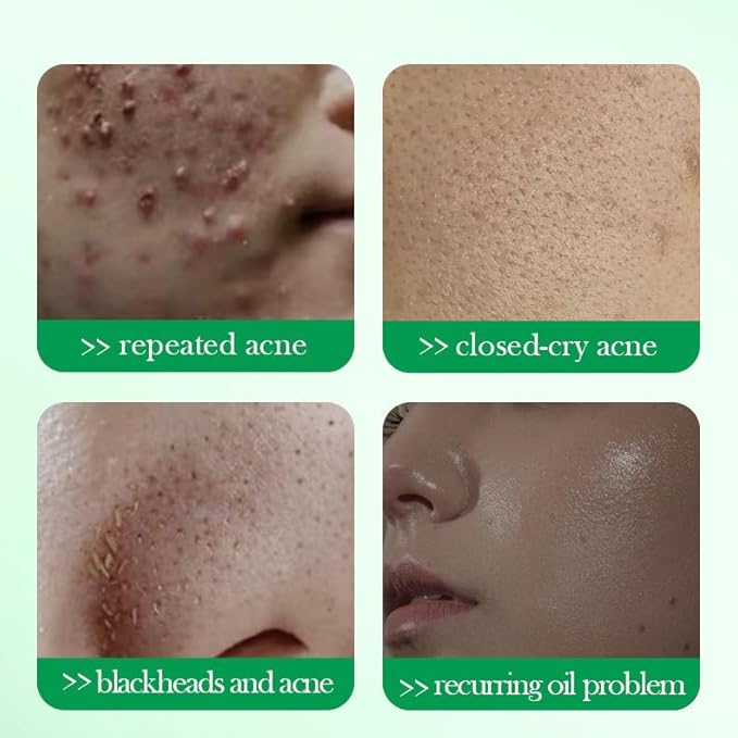 1 PC Salicylic Acid Cotton Pads Salicylic Acid Mask, Purifying Oil Control Deep Cleansing Soothing Mask For Face, 110g