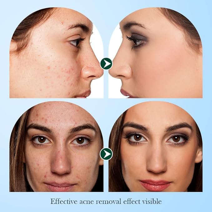 Tea Tree Oil for Face - Acne Serum - Unclog Pores, Soothe Breakouts - Blemish Spot Treatment for Smooth, Glowing Skin - Tea Tree Oil for Skin, 1.1 Fl Oz