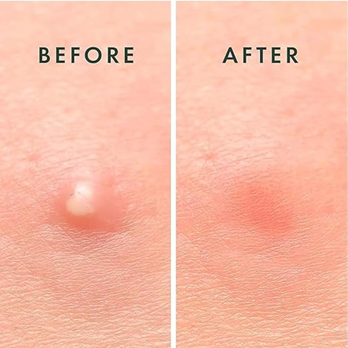 ABC Pimple Patches (108 Count)