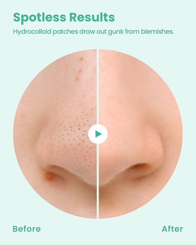GLAM UP Spotless Nose Patch Hydrocolloid Coverage for Nose Pores, Zits and Oil - Overnight Strong Waterproof to Absorb Blackheads & Pimple Nose Gunk, and Calm with Tea Tree (12 Patches)
