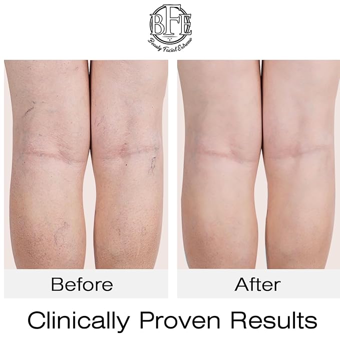 Vitamin K Cream- Moisturizing Bruise Healing Formula. Dark Spot Corrector for Bruising, Spider Veins & Broken Capillaries. Reduces Under Eye Dark Circles, Fine Lines, Puffiness, & Wrinkles.