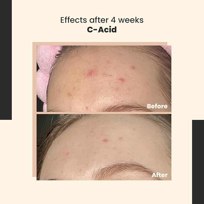 C-Acid Vitamin C & AHA Face Serum – Advanced Exfoliating and Brightening Treatment – Designed for Night Use with Lightweight Finish – 10% AHA Blend – 30 ml/Net 1.01 Fl. Oz