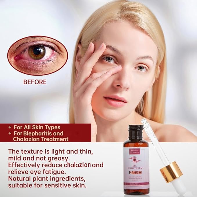 Chalazion Eye Treatment For Blepharitis, 30ml Moisturize Eyelids Serum and Chalazion Remover, Gentle Under Eye Relief Serum For Dark Circles, Eye Bags, Puffiness.