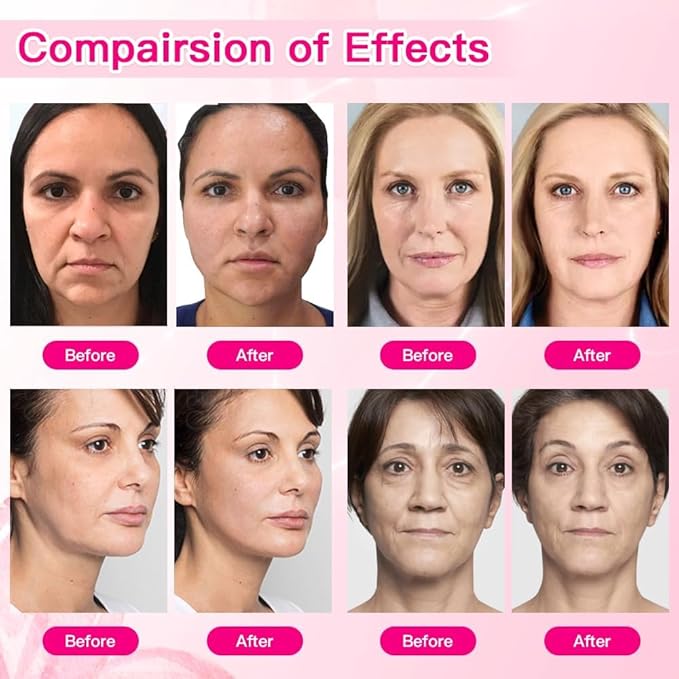 PDO Thread For Face Lift/Whole Body Lift Mono Thread Sharp (Mono 30G 13mm 20pcs)