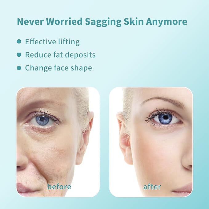 Pdo Threads Pdo Threads Lift for Face Smoothing Wrinkles Pdo Screw Threads Producs Collagen Pdo Lifting Threads Skin Tighten 26g50mm 40Pcs