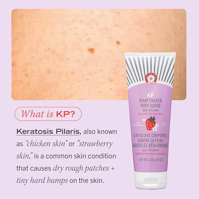 First Aid Beauty - KP Bump Eraser Body Scrub with 10% AHA, Keratosis Pilaris Exfoliator with Glycolic and Lactic acids, Helps Reduce Chicken Skin Bumps, Safe for Sensitive Skin, Strawberry Scent, 8 oz