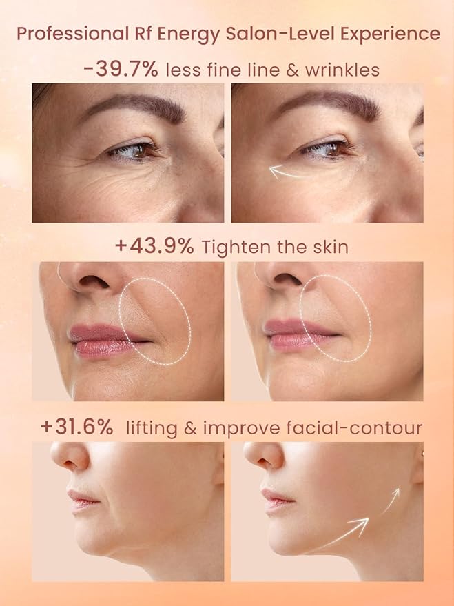 Radio Frequency Skin Tightening Device, Anti-Aging Face Machine for Wrinkle Removal, Lifting & Firming, Wireless Home Beauty Device with 3 Levels, at-Home Skin Renewal