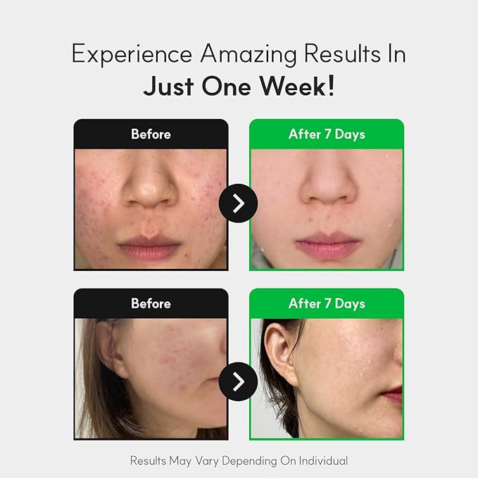 Centelsome 5X Soothing Serum 1.69 fl oz/50ml | for Hydration, Glow, Sensitive, Anti Aging, Acne treatment for Face, Korean Skincare with Centella Asiatica, Exosomes for Skin, Panthenol