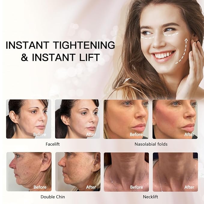 Pdo Thread(Mono screw 27G 50MM) For Face Lift/Whole Body Lift Mono Screw Type/Pdo Mono Screw Thread Sharp 27G 50mm (50pieces)