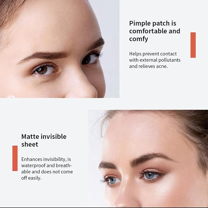 ZitZap Pimple/Acne Patches For Face And Skin, Hydrocolloid Patches With Salicylic Acid And Tea Tree Oil For Covering Zits And Blemishes.