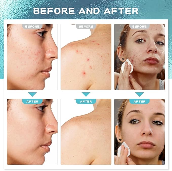 Acne Treatment for Face: Salicylic Acid Serum for Acne-Prone Men Women - Pimple Cream for Body Back