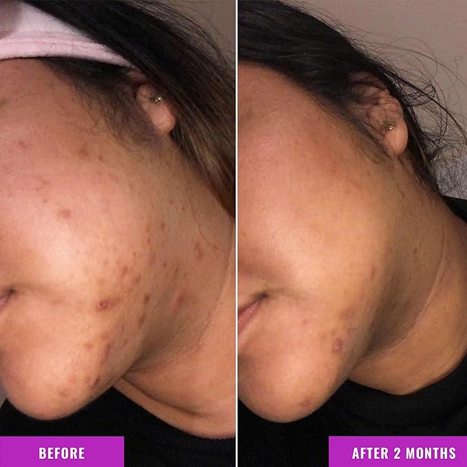 Good Molecules Discoloration Correcting Serum - Tranexamic Acid and Niacinamide for Dark Spots, Sun Damage, and Age Spots - Skincare Face