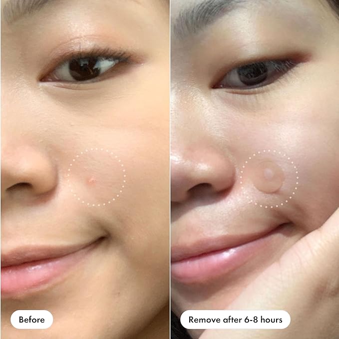 Mighty Patch™ Original Patch - Hydrocolloid Acne Pimple Patch for Covering Zits and Blemishes, Spot Stickers for Face and Skin (75 Count)