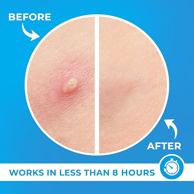 PatchRx Pimple Patches for Face (500 Patches), Hydrocolloid Acne Patches with Tea Tree Oil, Pimple Patch Pimple Stickers - Hydrocolloid Patch Acne Dots - Acne Pimple Patches For Face - Zit Patches