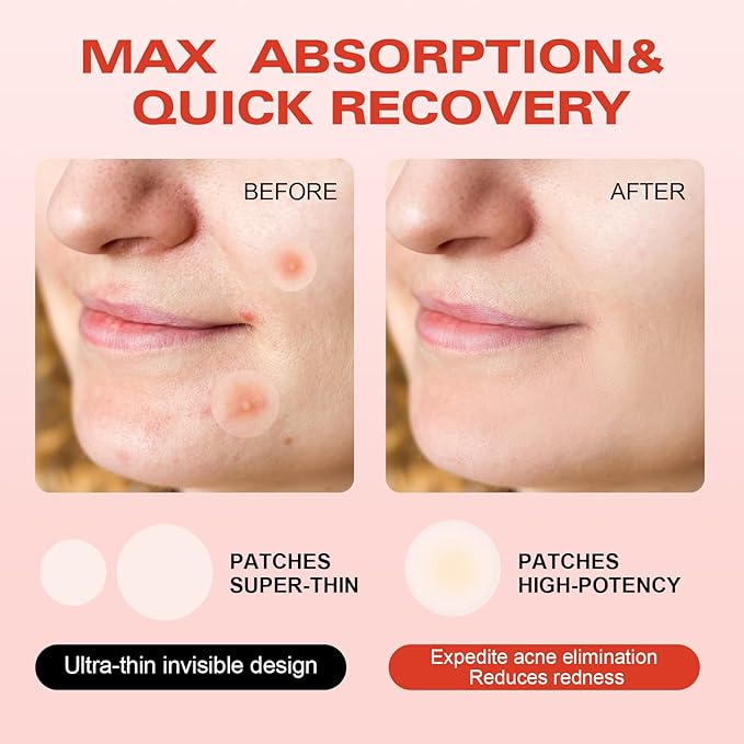 Pro Microdarts Nano Patch,Pro MicroDarts Patch–Acne Pimple Patches, Invisible Blemish Cover, Suitable for All Skin Types (1 Box)