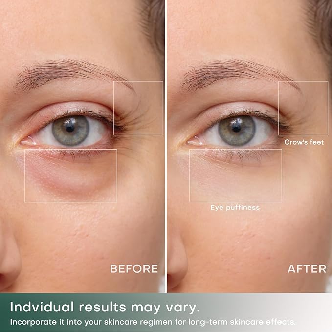 Puffiness Under Eye Bags Wrinkles Fine Line Reduce Device With Gold Plated Treatment Head Current Radio Frequency Wireless Professional RF Skin Care Beauty Device (With Gel)