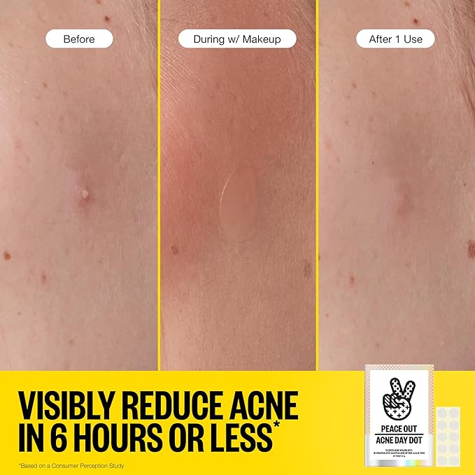 PEACE OUT Acne Day Dot, Sheer Acne Healing Dots, Virtually Invisible Wear, Hydrocolloid Pimple Patches Helps Clear Blemishes Quickly with Encapsulated Salicylic Acid, Retinol & Aloe Vera, 40 dots