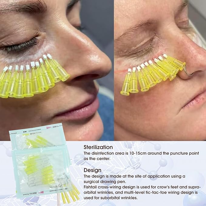 ACADA Pdo Threads for Eye Lift Face Lift Pdo Screw Threads for Eyes lift 30G25mm 40Pcs B-Type, Pdo Periocular Threads, Pdo Threads Eyes