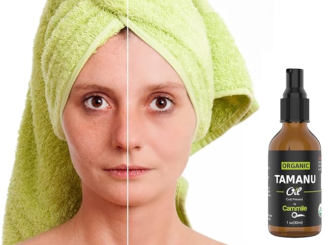 Organic Tamanu Oil - Natural Psoriasis Treatment - Great For Eczema, Acne & Scars - Cold Pressed