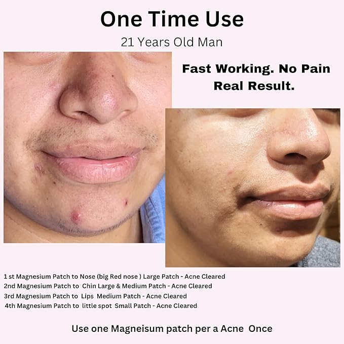 FreeGo Magnesium Acne Patches for Face. Blemish.Zit & Dark Spots from Post-Blemish, Acne .Zit. Self Dissolving,Hydrocolloid, Tee Tree oil & more (M 10pc)