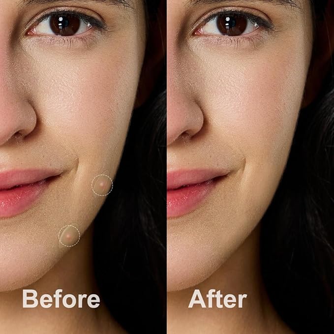 Pimple Patches for Face, Hydrocolloid Acne Patches, Absorb Zits and Blemishes, Invisible Spot Cover, Treatment for Breakouts, Acne Stickers with Salicylic Acid and Tea Tree Oil (72 Count)