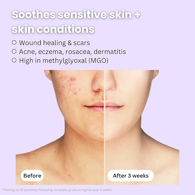 Save 5%: Organic Manuka Honey + Bee Venom Day and Night Cream Duo | Bee Venom Skin Treatment | Manuka Honey Skincare | 2oz/60ml