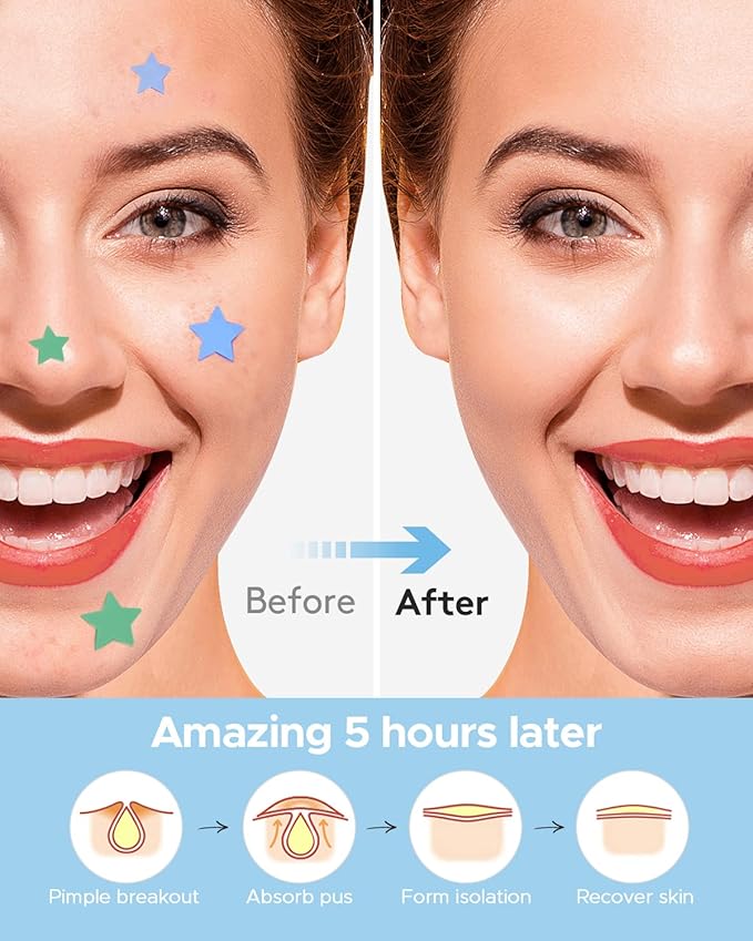 LitBaer Star-Shaped Pimple Patch Hydrocolloid Acne Stickers with Tea Tree Oil + Salicylic Acid, Cover Dot for Acne Blemish, Pimples, Whiteheads, Zit, Draw out Oil & Impurities, 112 Dots, 14mm & 10mm