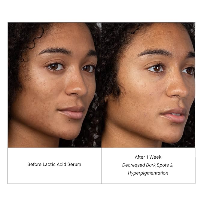 SHANI DARDEN SKIN CARE Lactic Acid Face Serum Travel Size, Active Night Serum to Help with the Look of Radiant and Smooth Skin, Gentle But Powerful Face Exfoliator, 0.34 fl oz