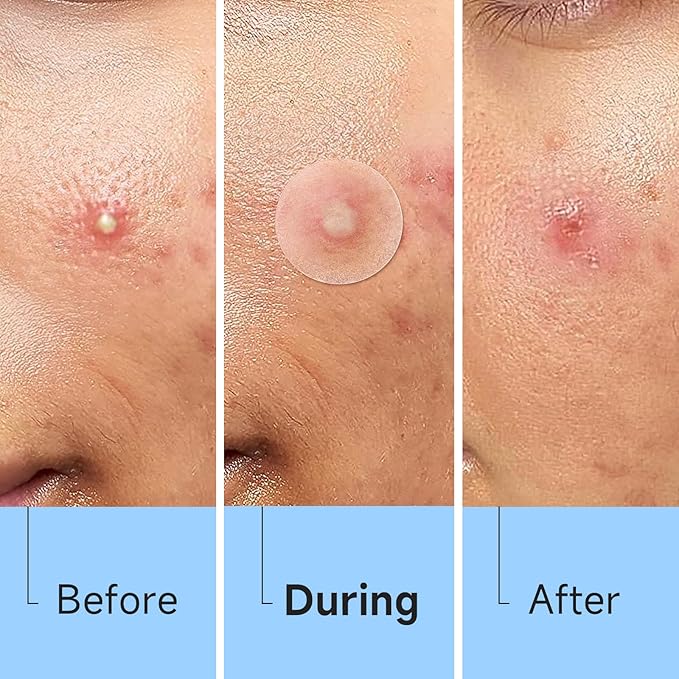 Pimple Patches for Face (504 Counts), Bulk Acne Patch, Zit Stickers 4 Sizes, Hydrocolloid Spot Stickers, Clear Acne Dots for Covering Zits, Blemishes and Breakouts