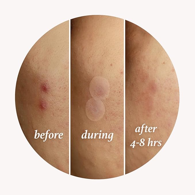 Julep Patch Me Up Waterproof Pimple Patches – 72 Hydrocolloid Acne Patches with Tea Tree Oil, Ultra-Thin Day & Potent Night, Reduces Blemishes & Scarring – 48 8mm & 24 12mm Patches