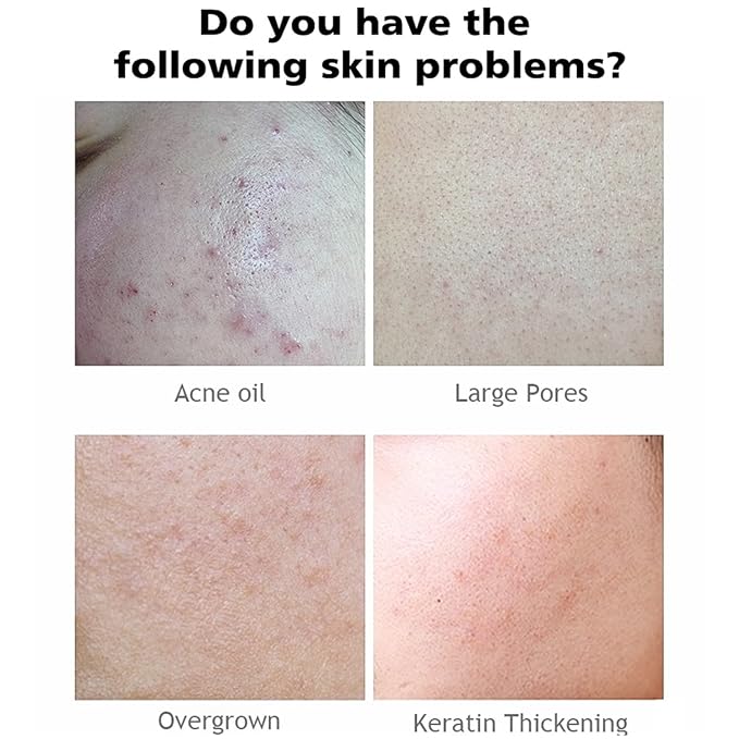 AICHUN BEAUTY Face Serum Eye Essence Anti-Wrinkles Anti-Acne Oil-Control Anti-Freckle Refreshing Moisturizing Purifying Shrink Pores 30ml 1.01FL.oz (AHA 30% + BHA 2% Exfoliation Face Serum)