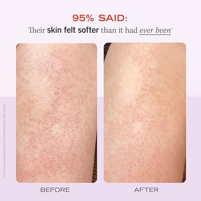 First Aid Beauty - KP Bump Eraser Body Scrub with 10% AHA, Keratosis Pilaris Exfoliator with Glycolic and Lactic acids, Helps Reduce Chicken Skin Bumps, Safe for Sensitive Skin, Strawberry Scent, 8 oz