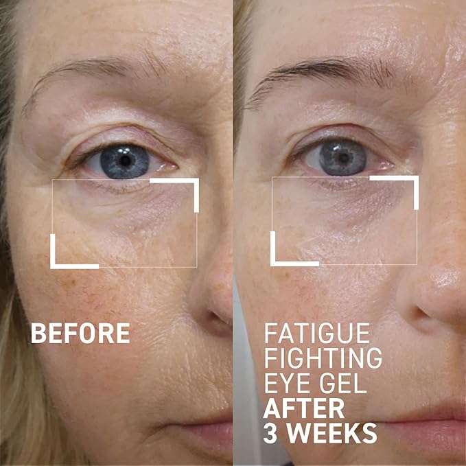 Dr. Brandt iD-STRESS Fatigue Fighting Eye Gel - 0.5 fl oz, Pack of 2 - Rapidly Diminishes Signs of Dryness, Fatigue & Dark Circles in the Eye Area