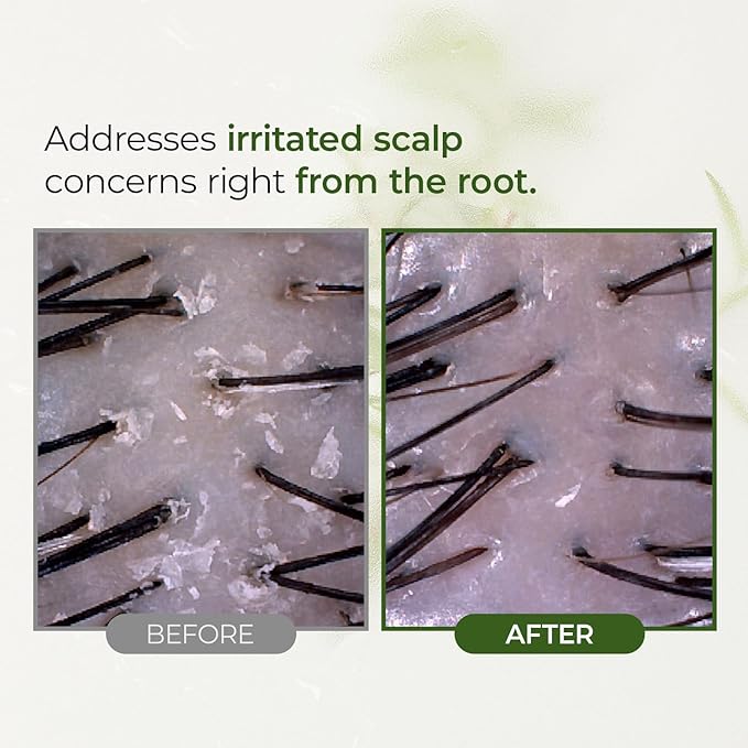 Tea Tree Scalp Water Scaler | Scalp Exfoliator for Itchy Dry Flaky Scalp, Buildup Remover, Treatment for Excess Sebum Oily Greasy Hair | Korean Hair Care Products, Travel Size, 1.69 fl oz