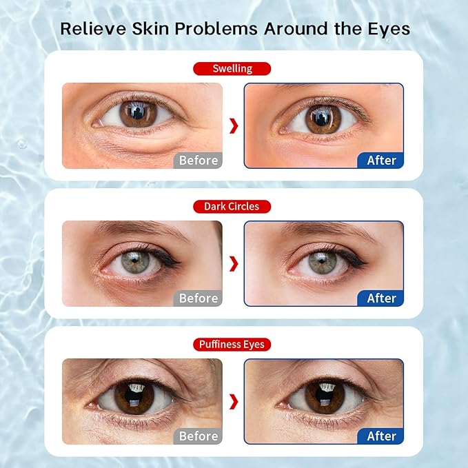 ZNÖCUETÖD Reusable Gel Eye Pads for Puffiness & Dark Circles - Cold/Warm Therapy Compress with Cooling Under Eye Patches, Reduces Wrinkles & Redness, Pain Relief Eye Mask for Relaxation