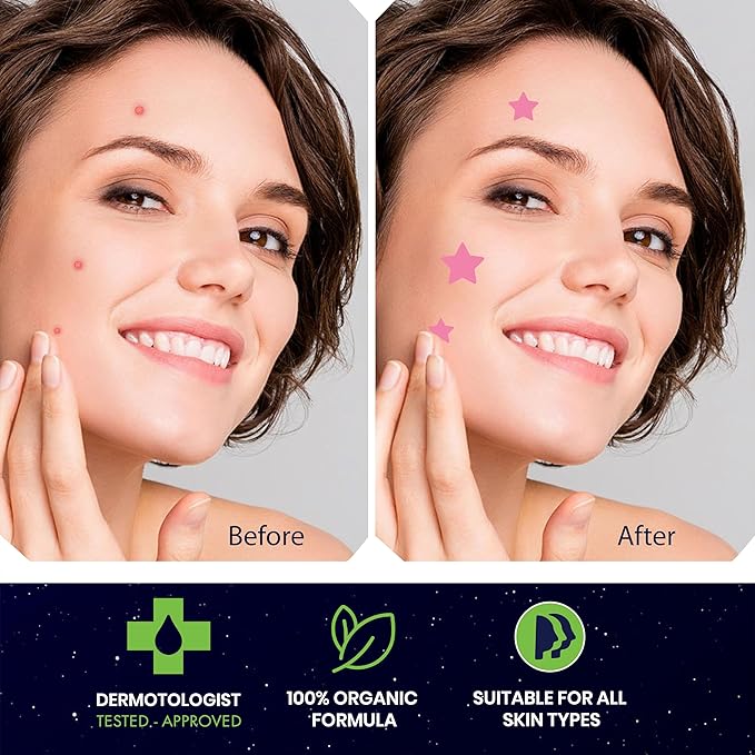 Star Pimple Patches for Face – Hydrocolloid Acne Patches for Quick Zit Relief And Blemishes, Invisible Spot Stickers That Stay All Night, Gentle for All Skin Types, Oil-Free (40 Count)