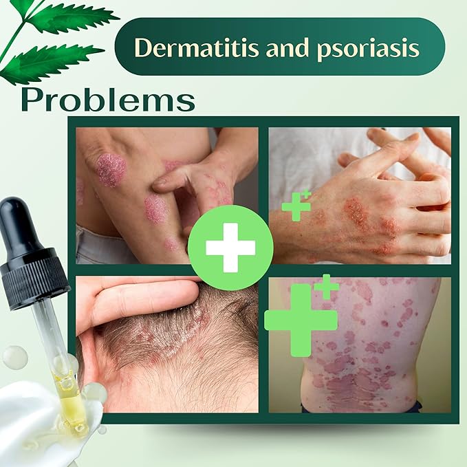 ABERA Alan Silver Serum - Clinically Proven to Soothe Irritated Skin and Improve The Appearance of Skin with Mild to Moderate Psoriasis