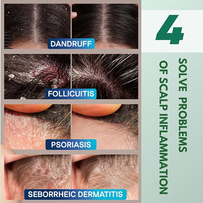 ABERA Alan Silver Serum - Clinically Proven to Soothe Irritated Skin and Improve The Appearance of Skin with Mild to Moderate Psoriasis