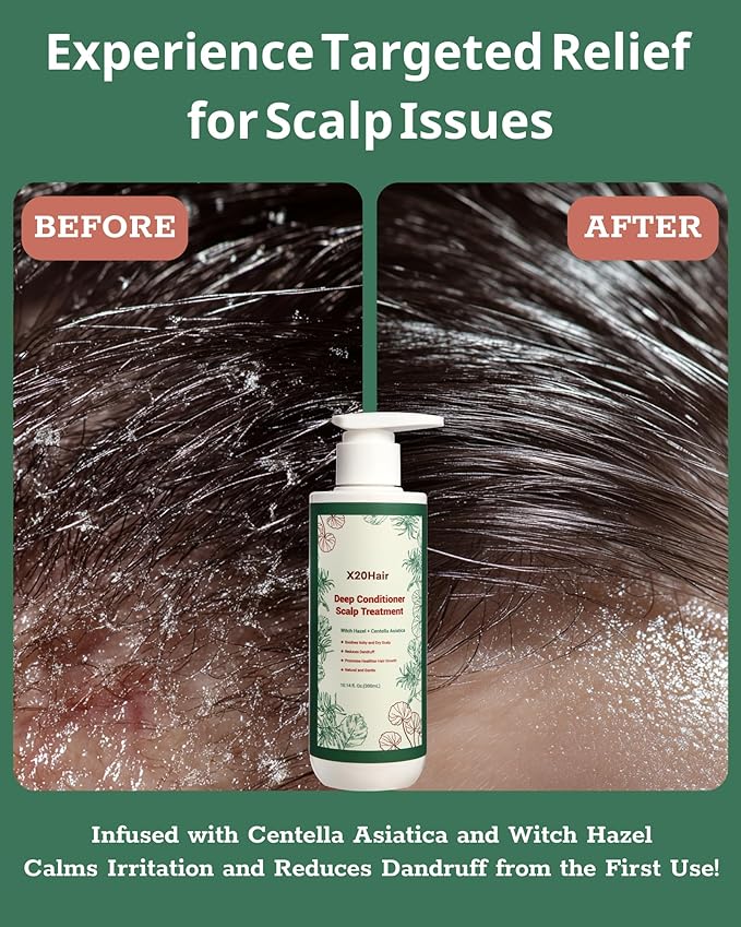 Deep Conditioner Scalp Treatment for Folliculitis - Relieves Dandruff, Psoriasis, Dryness & Itchiness, Balances Oil, Ideal for Women