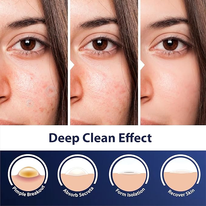 Dot Pimple Patches for Face – Hydrocolloid Acne Patches for Quick Zit Relief And Blemishes, Invisible Spot Stickers That Stay All Night, Gentle for All Skin Types, Oil-Free (40 Count)