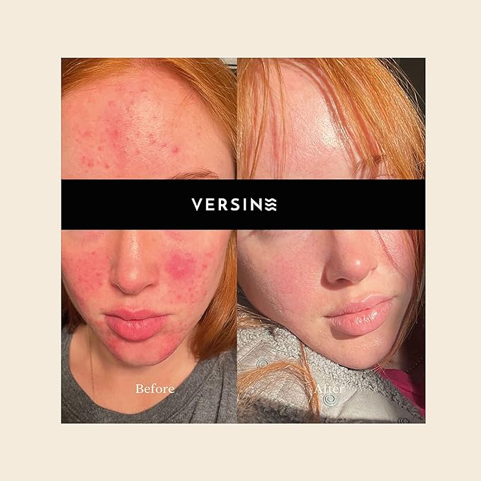 Versine Gentle Actives Serum for Face | Acne Prone Skin | Pregnancy Safe with Azelaic Acid, Vitamin C, Squalane, Niacinamide, Hyaluronic Acid | Moisturizer, Anti Aging and Brightening | 1Fl Oz