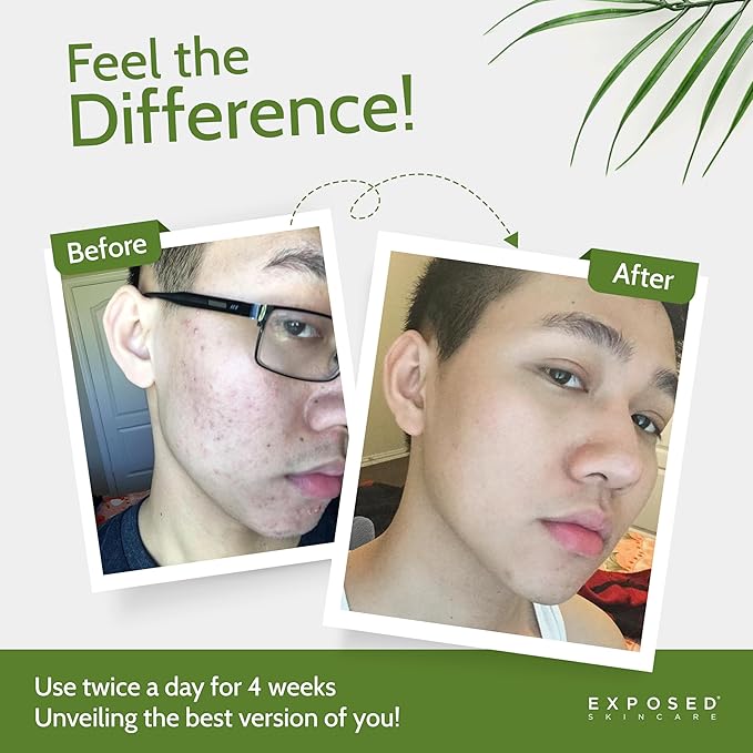 Exposed Skin Care Acne Treatment Kit - Includes Facial Cleanser, Clearing Tonic, Acne Treatment Serum, Clear Pore Serum, Clarifying Mask, Cloth - Natural Acne Solution for Face, All Ages & Skin Types