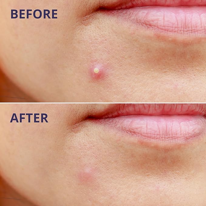 Pimple Patches for Face (96 Count). Invisible Hydrocolloid Acne Patch for Blemishes, Zits, and Breakouts. Easy-to-Use Spot Cover for Day & Night, Medium Size (12mm)