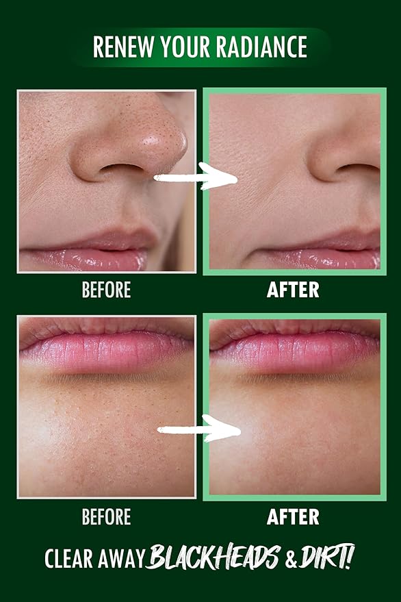 [K-Beauty] Neogen Dermalogy Pore Zero Peeling Mousse | All-in-One Foaming Exfoliating Face Wash Visibly Firming, Tightening & Lifting Skin 3.38 fl oz