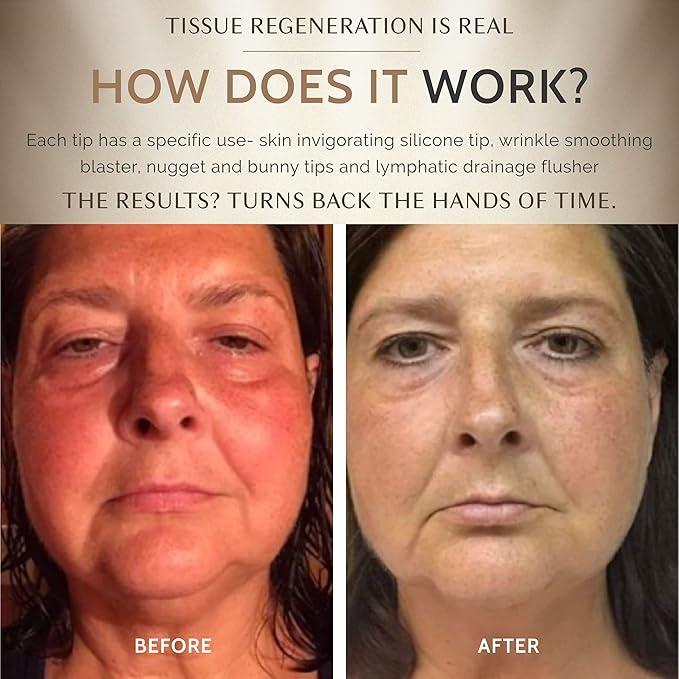 The OMG Blaster 5-in-1 Face Lifting Tool by Ashley Black. Patented Technology for Fine Lines, Wrinkles, Skin Tightening, Face Contouring, Lymphatic Darinage and Temporary Blood Flow