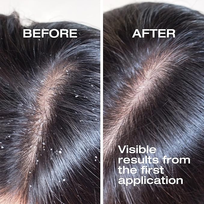 Hair Therapy Pro Ampoule - Detox - Capillary Anomalies - Dandruff Treatment | Dry Scalp | (3 Pack) 36ml.