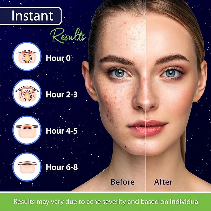 Star Pimple Patches for Face – Hydrocolloid Acne Patches for Quick Zit Relief And Blemishes, Invisible Spot Stickers That Stay All Night, Gentle for All Skin Types, Oil-Free (40 Count)