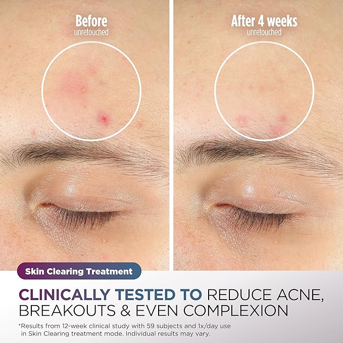 Shark CryoGlow LED Face Mask (FSA/HSA Eligible*) with Under-Eye Cooling, Anti-Ageing & Blemish Repair, Red & Blue LED, Infrared Light Therapy, USB-C, Remote Control, Storage Bag, Blue Frost, FW312